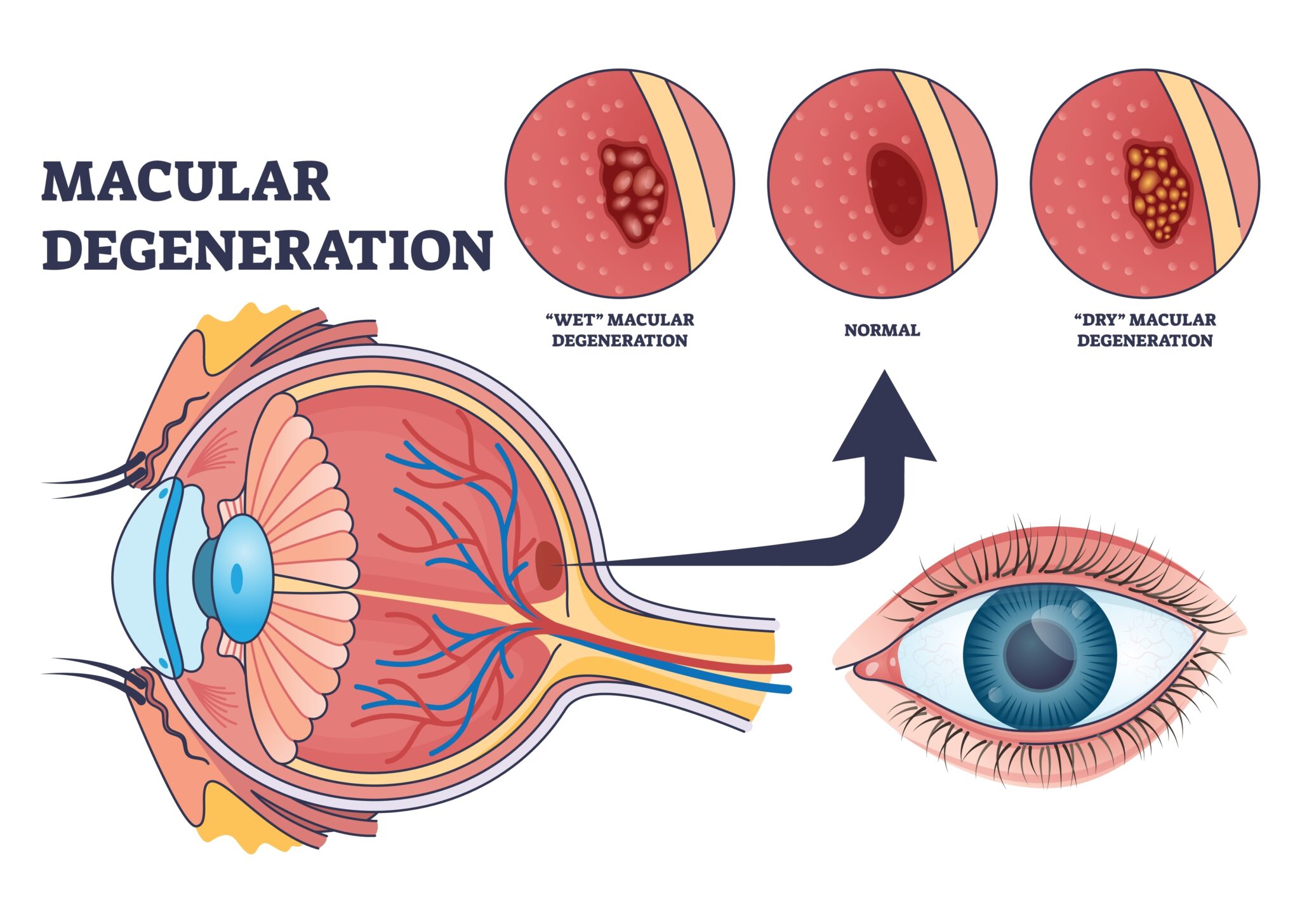 Macular Distorted Vision Wet Macular Degeneration vs. Dry Macular Degeneration: What's the ...